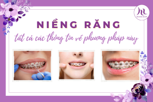 niềng răng